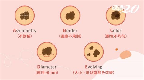 胸部紅色痣|是痣or皮膚癌？醫「1張圖秒對照」 長這2部位最危險